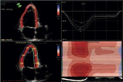 Ecocardiografia técnicas avançadas